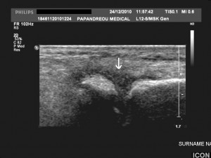 Εικόνα 6: Πάχυνση του αρθρικού υμένα της μεταταρσοφαλαγγικής άρθρωσης του τρίτου δακτύλου του δεξιού άκρου πόδα (βέλος). Ίδιο περιστατικό.